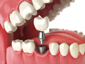 Dental Implants in Guwahati