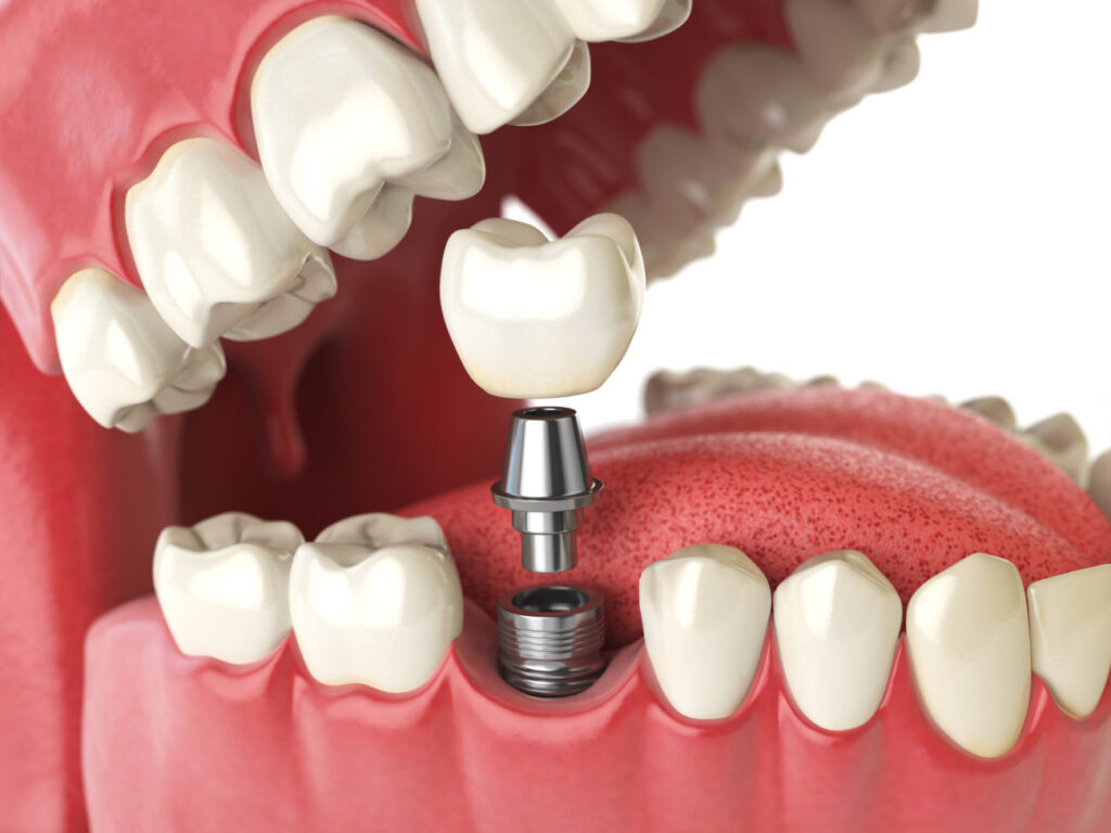 Are Dental Implants the best solution for Teeth Replacement?