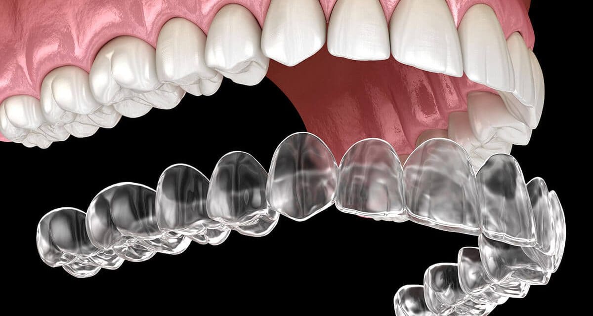 COST OF ALIGNERS in guwahati