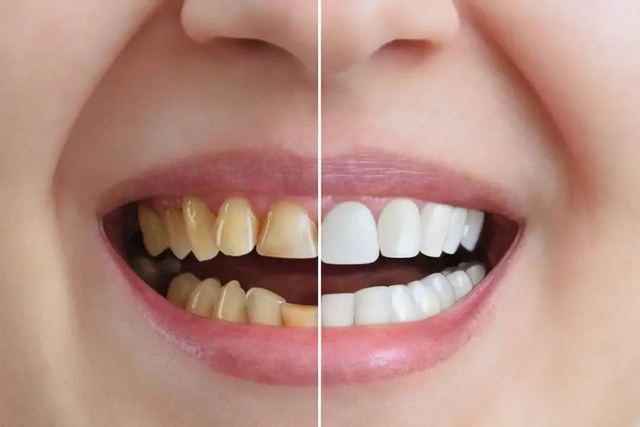 The Best Way to Whiten Your Teeth