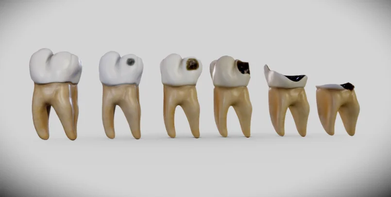 Children and Cavities
